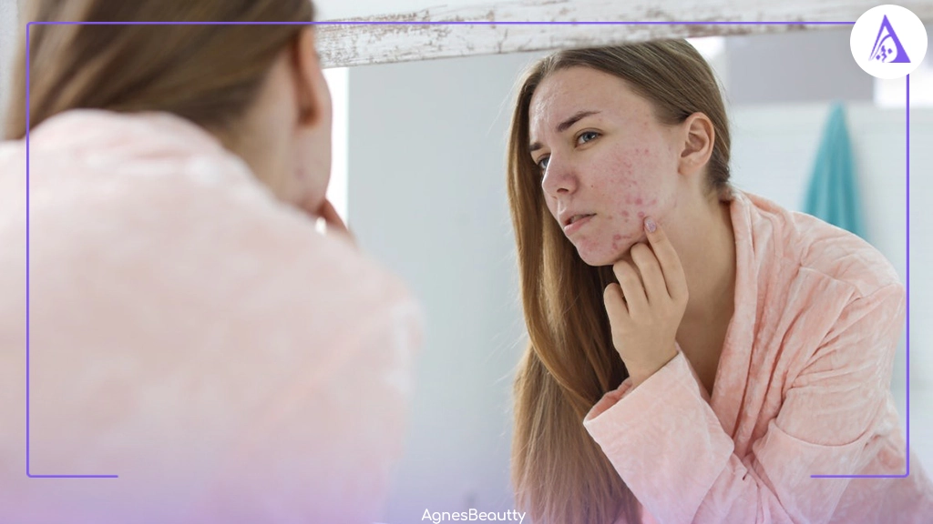 کمبود کدام ویتامین باعث لک صورت می شود؟