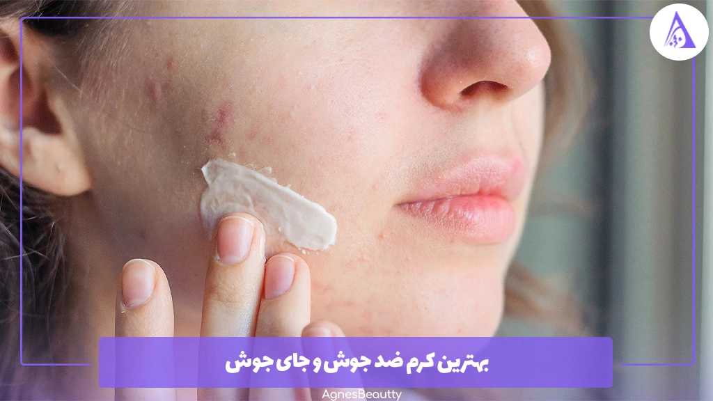 بهترین کرم ضد جوش و جای جوش
