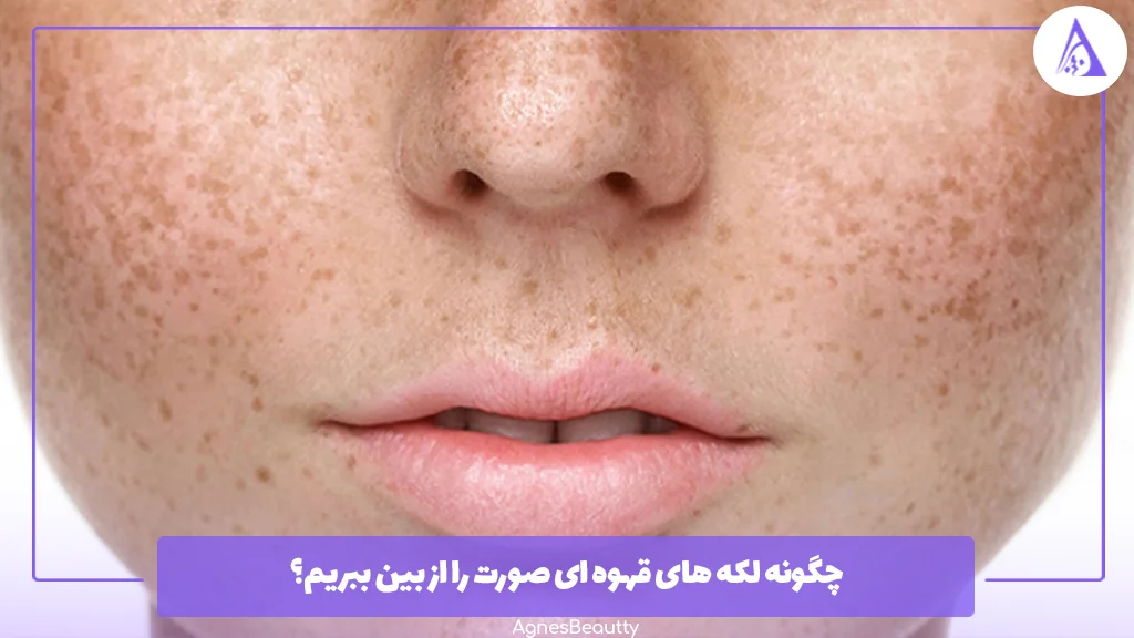 چگونه لکه های قهوه ای صورت را از بین ببریم؟