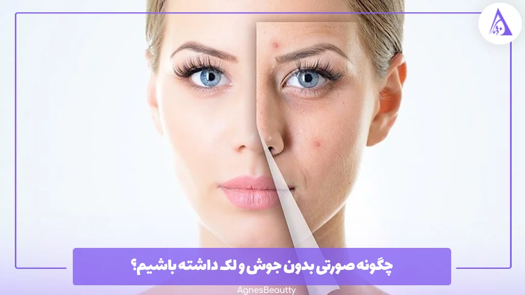 چگونه صورتی بدون جوش و لک داشته باشیم؟