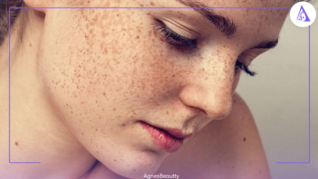 چه روش هایی برای درمان لکه های قهوه‌ای وجود دارد؟