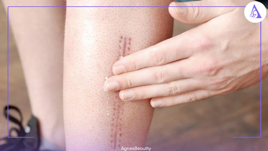 نحوه عملکرد کرم ترمیم کننده در رفع جای بخیه