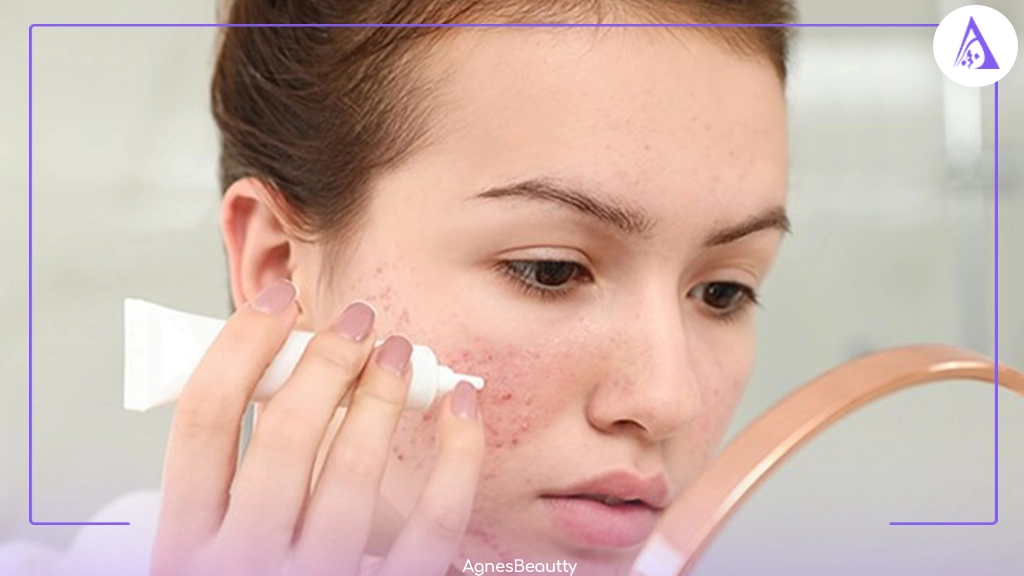 کرم ضد جوش را چگونه استفاده کنیم؟