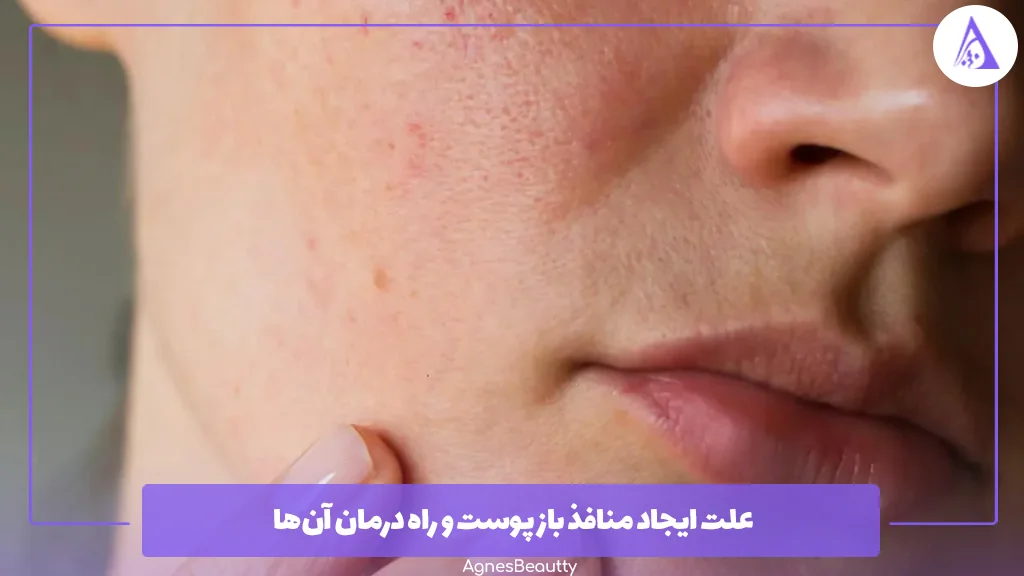 علت ایجاد منافذ باز پوست و راه درمان آن‌ها