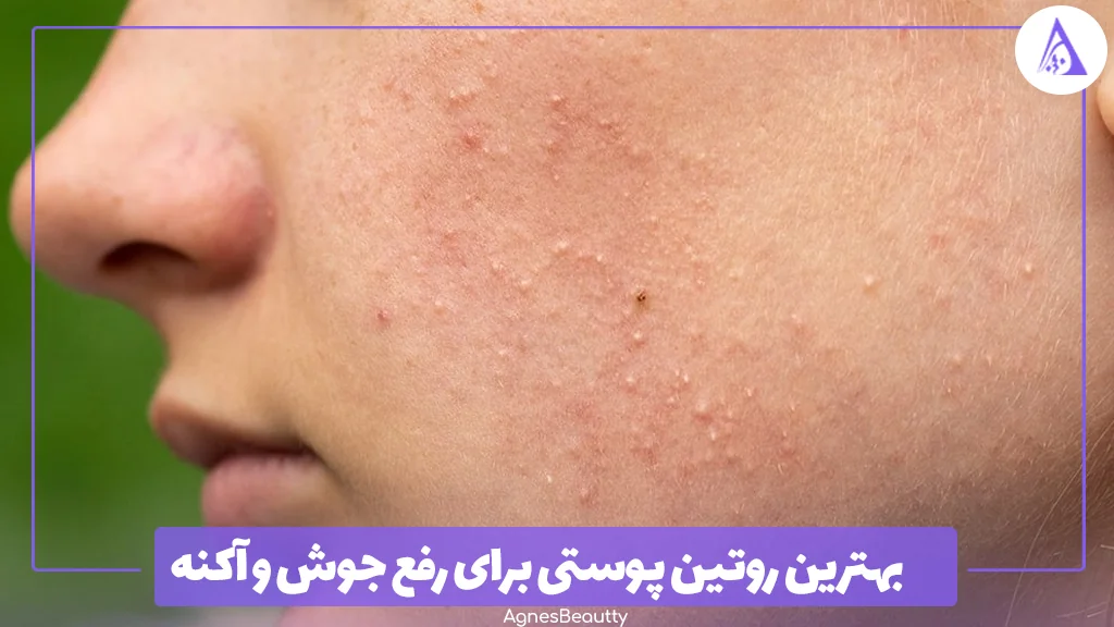 بهترین روتین پوستی برای رفع جوش و آکنه