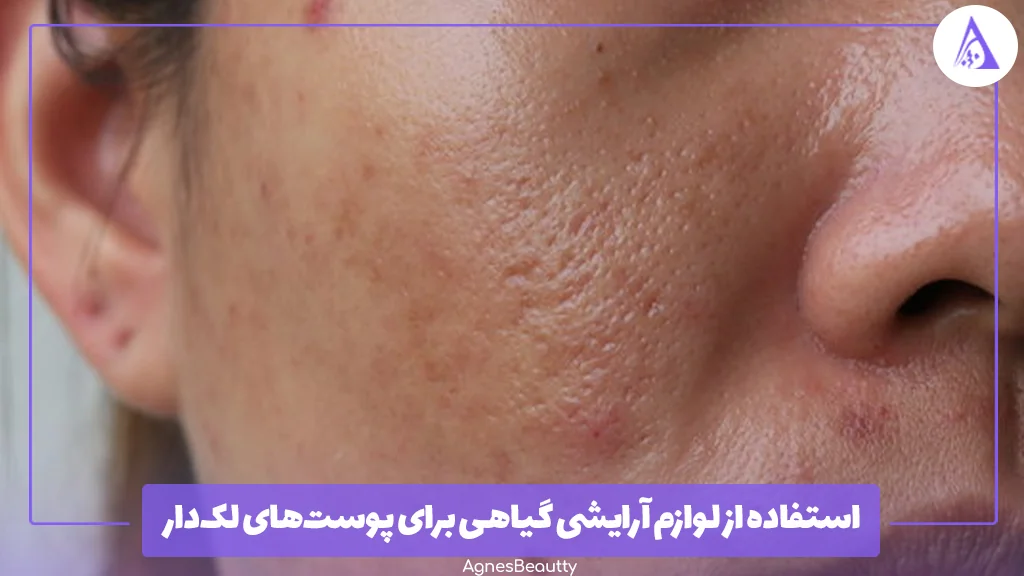 استفاده از لوازم آرایشی گیاهی برای پوست‌های لک‌دار