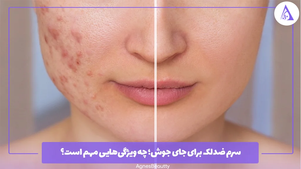 سرم ضدلک برای جای جوش؛ چه ویژگی‌هایی مهم است؟