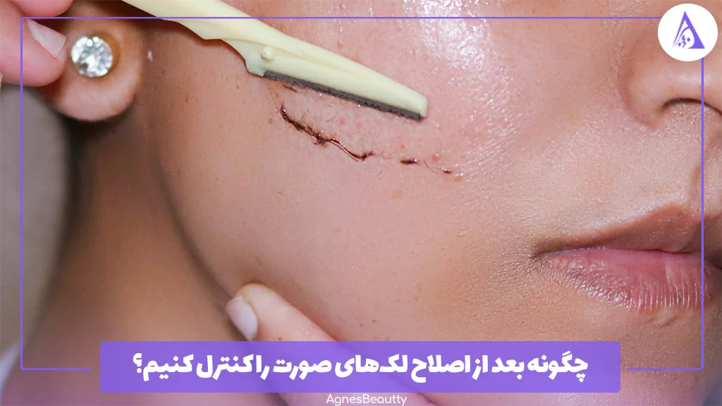 چگونه بعد از اصلاح لک‌های صورت را کنترل کنیم؟ 