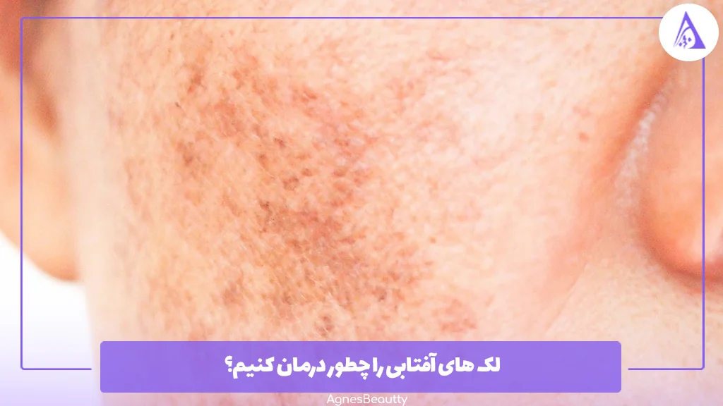 لک های آفتابی را چطور درمان کنیم؟