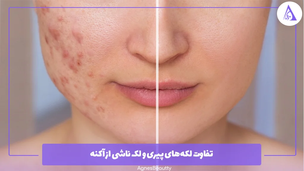 تفاوت لکه‌های پیری و لک‌ ناشی از آکنه 