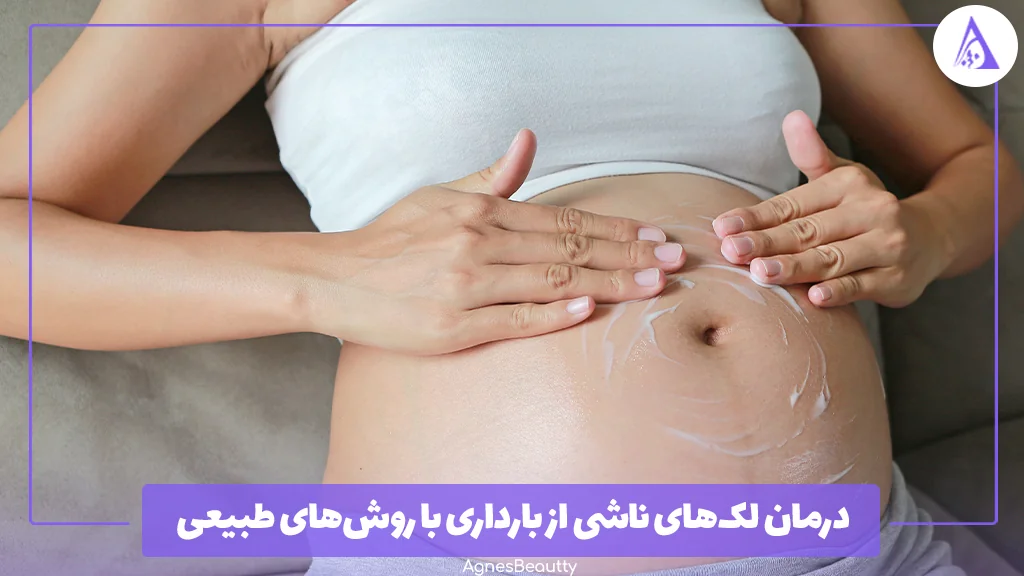 درمان لک‌های ناشی از بارداری با روش‌های طبیعی