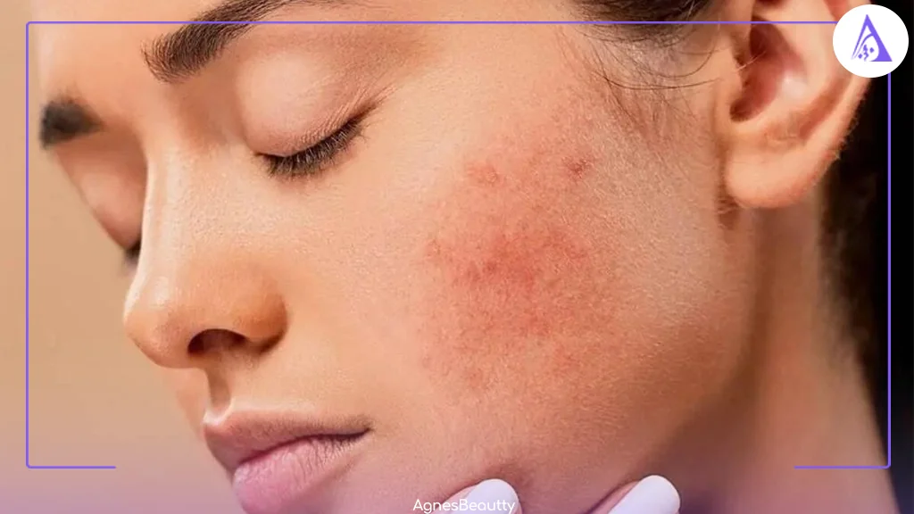 دلیل نیاز پوست های خشک و حساس به مراقبت ویژه چیست؟