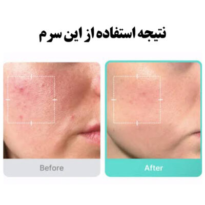 سرم تسکین دهنده آزلائیک اسید 16% مدی کیوب