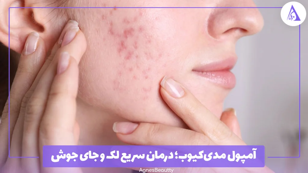 درمان سریع لک و جای جوش