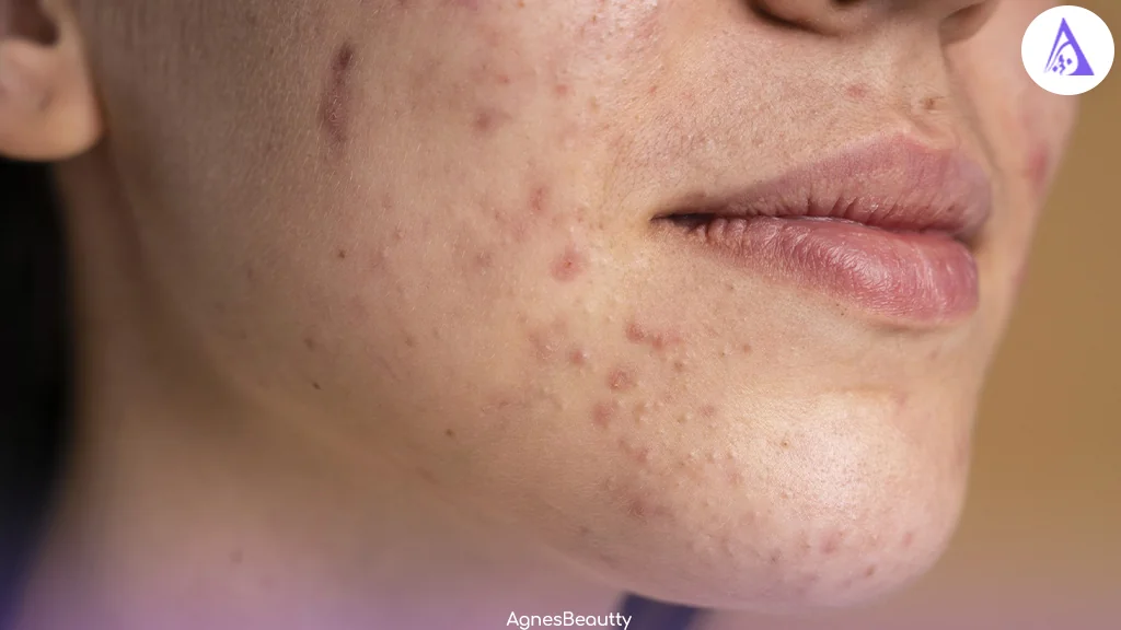 دلیل به وجود آمدن جای جوش و لک