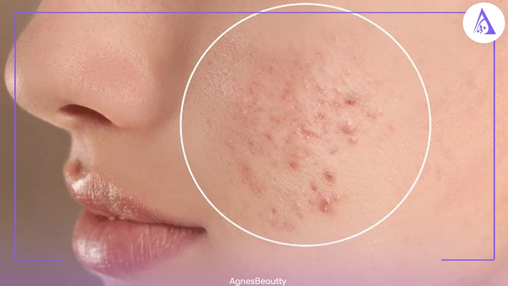 منظور از جوش زیرپوستی چیست و چرا به وجود می‌آید؟