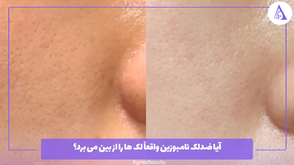 آیا ضدلک نامبوزین واقعاً لک‌ ها را از بین می‌ برد؟