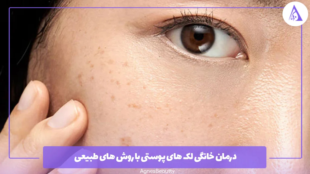 درمان خانگی لک ‌های پوستی با روش ‌های طبیعی